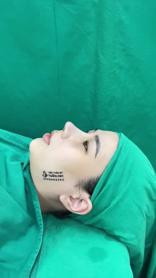 Ca nâng mũi cấu trúc sụn sinh học mỹ vừa xong