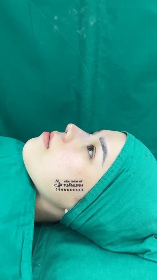 Case mũi cấu trúc vừa hoàn thành cho bạn gái đã tiêm filler