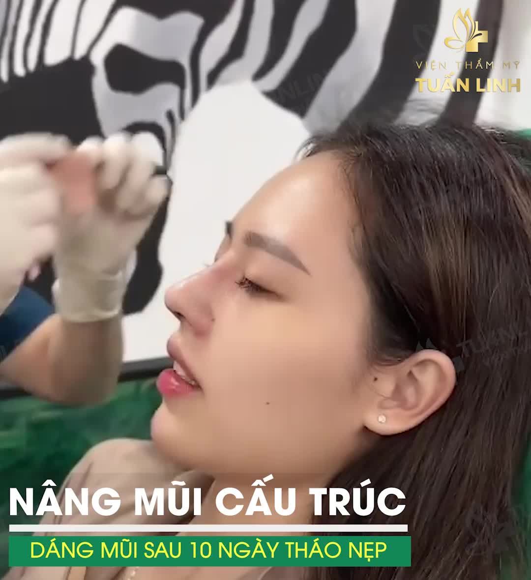 Cận cảnh chiếc mũi cấu trúc sau 10 ngày tháo nẹp!!