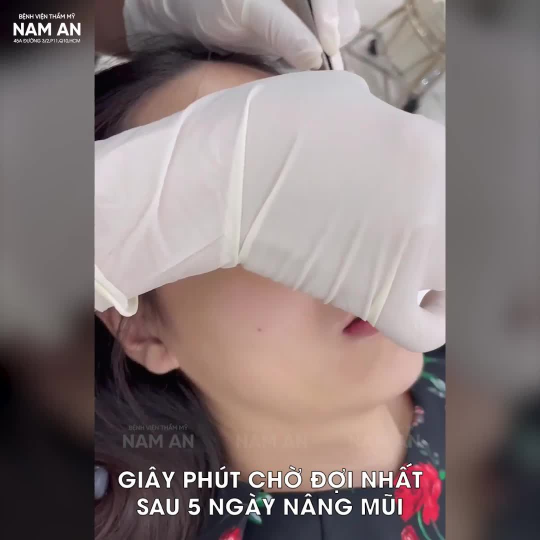 MŨI CẤU TRÚC SỤN SƯỜN 5 NGÀY THÁO NẸP.