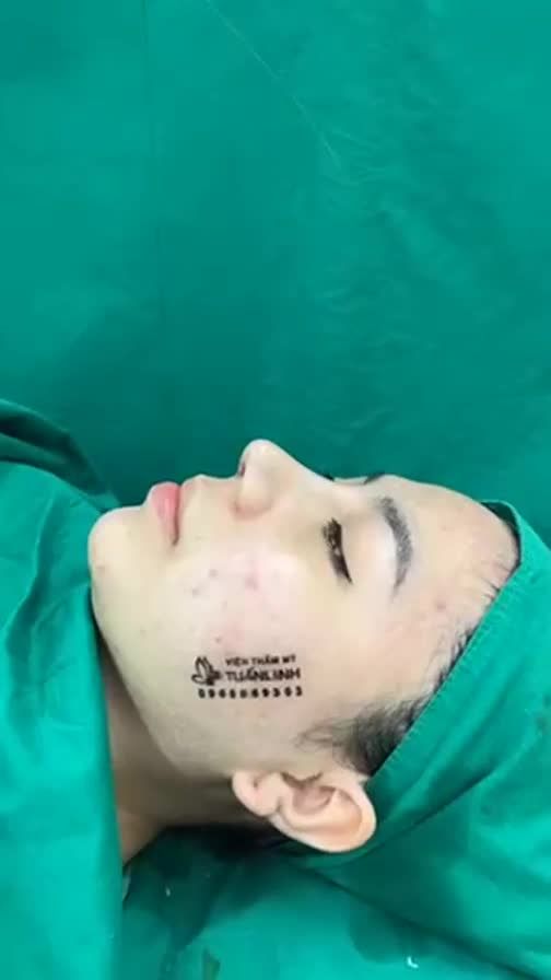 Case mũi cấu trúc vừa hoàn thành