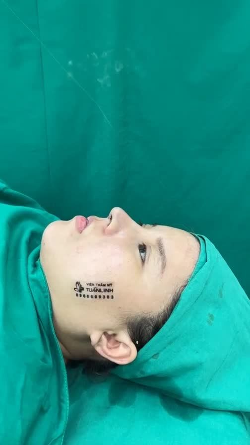 Case mũi cấu trúc + cắt môi  vừa hoàn thành