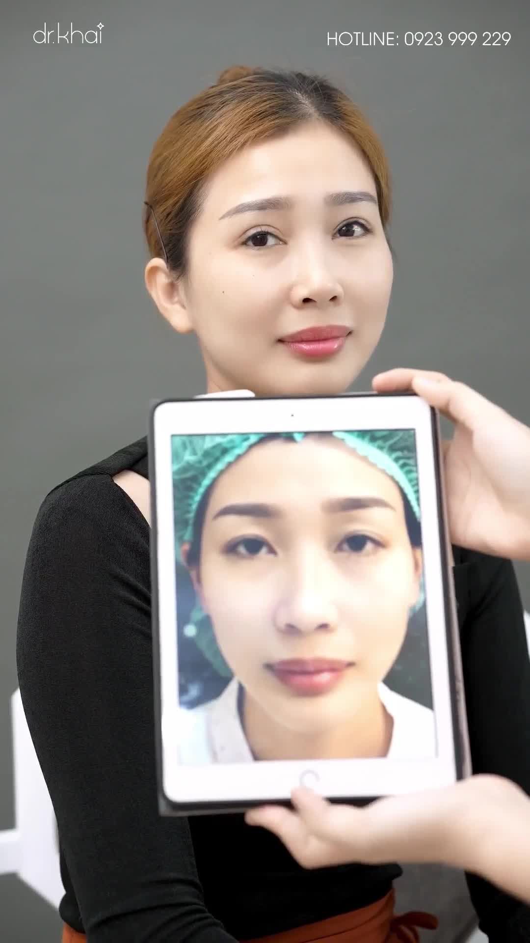 KHÁCH HÀNG CHỈNH XƯƠNG SÓNG MŨI BỊ GỒ