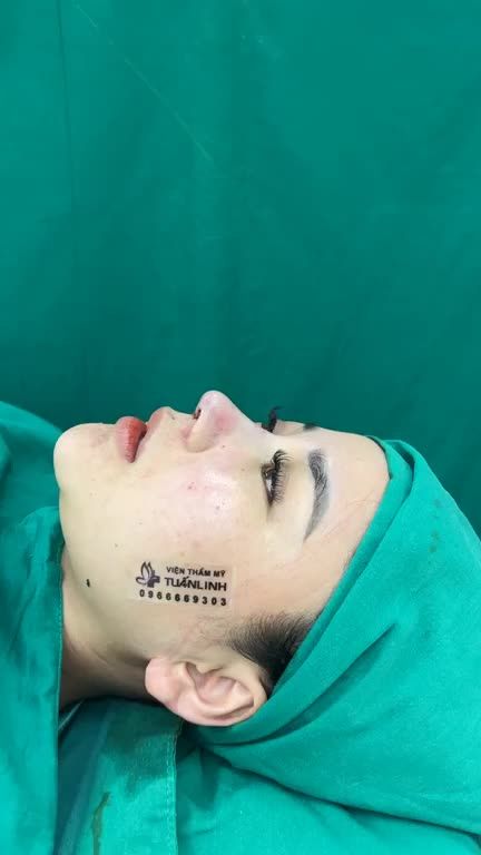 Case mũi cấu trúc vừa hoàn thành