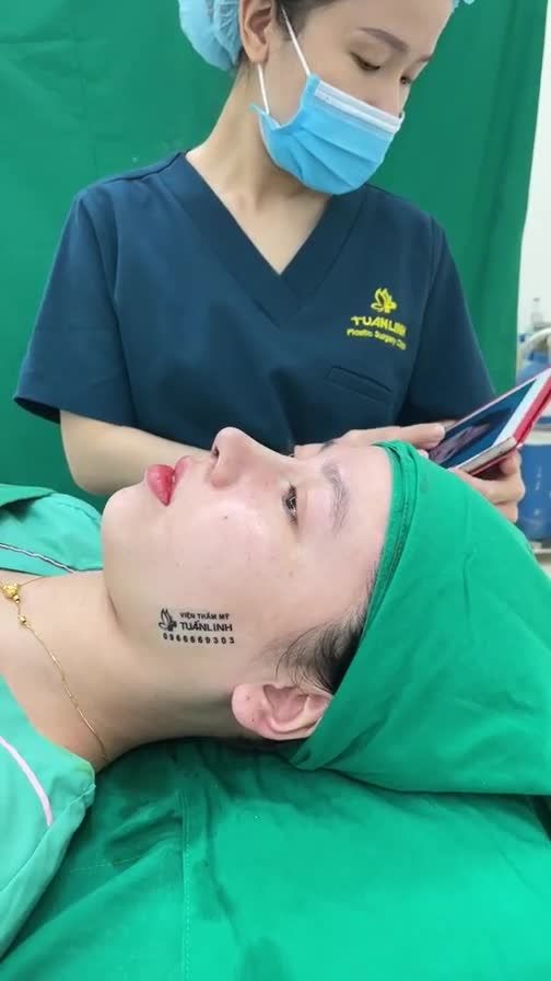 Ca nâng mũi cấu trúc  sụn sinh học mỹ vừa hoàn thành