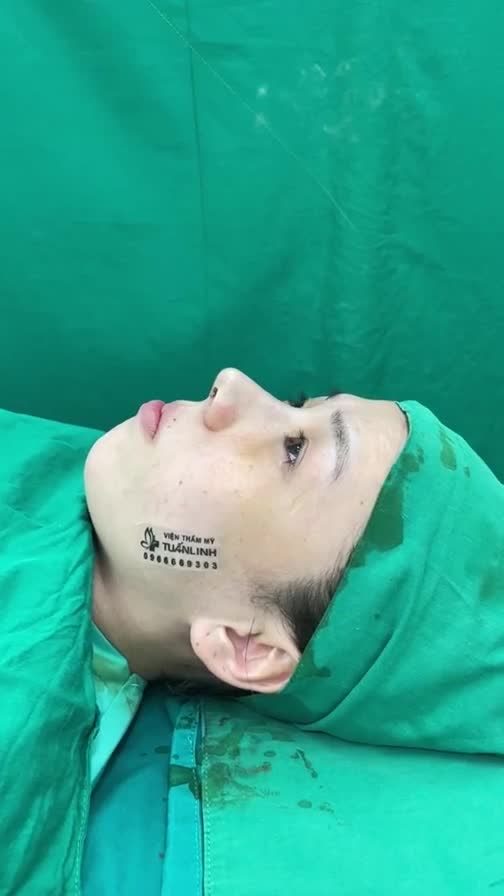 Ca mũi cấu trúc sụn sinh học mỹ vừa  hoàn thành