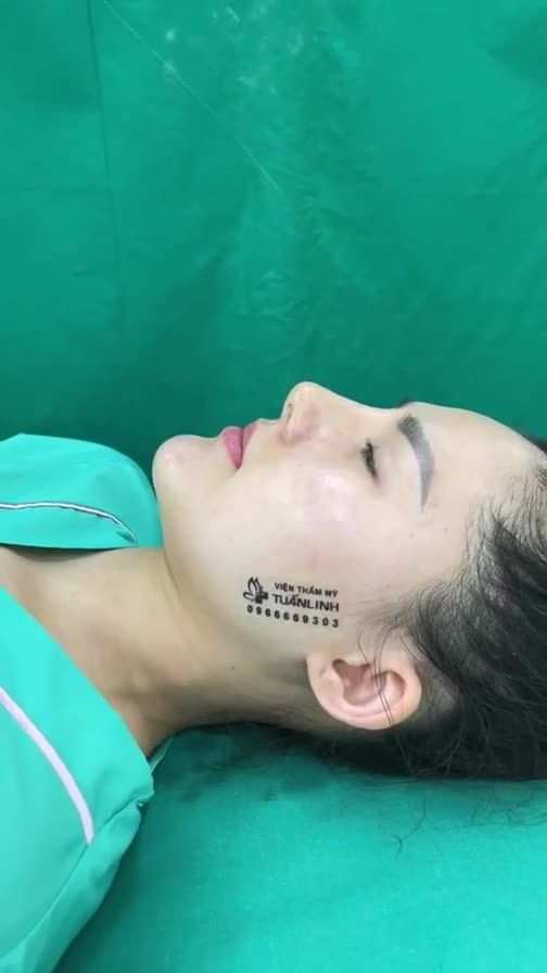 Ca độn cằm  sụn sugrifom  vừa hoàn thành