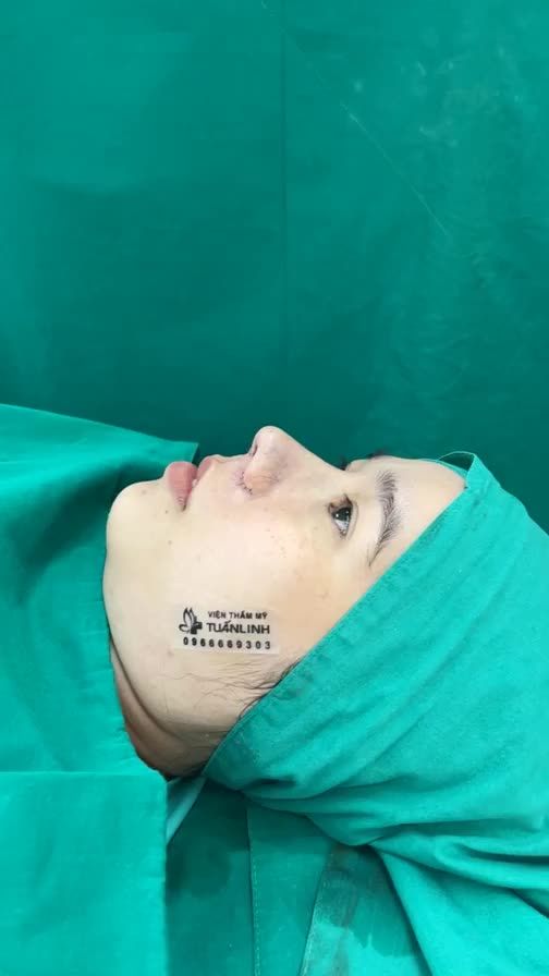 Case mũi cấu trúc vừa hoàn thành