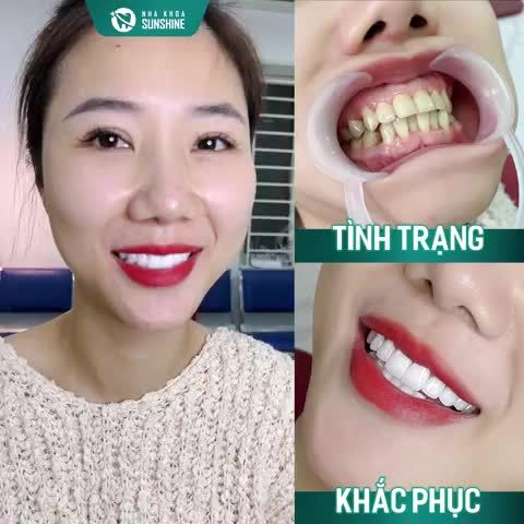 Quá trình làm răng diễn ra nhanh chóng, bác sĩ nhẹ nhàng và tận tâm. Cảm ơn đội ngũ bác sĩ đã thiết kế cho mình nụ cười ưng ý này”.