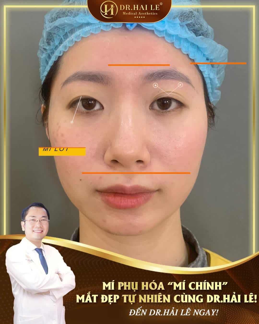Đôi mắt nhiều mí phụ khiến đôi mắt không có chiều sâu, ảnh hưởng nhiều đến thẩm mỹ của cả khuôn mặt.