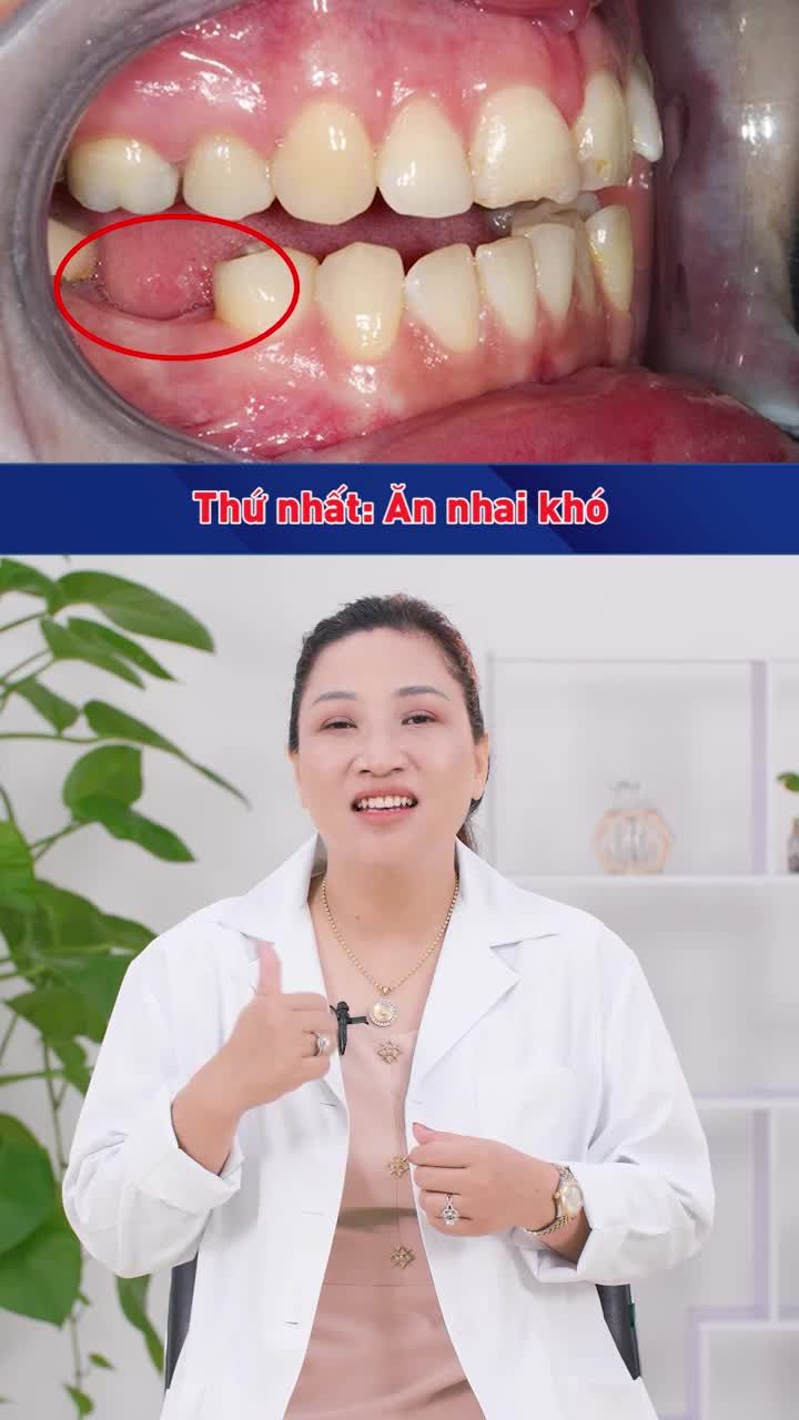 TRỒNG RĂNG IMPLANT BẮT VÍT VÀ XI MĂNG KHÁC GÌ NHAU?