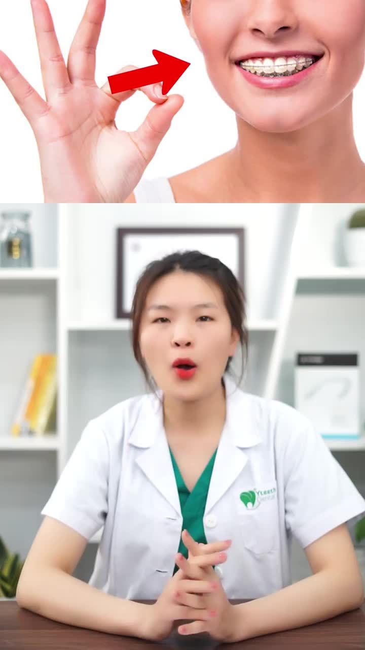 Niềng răng có bị hóp má không?