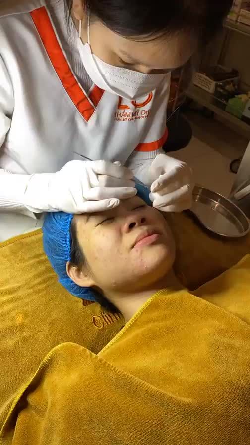Nặn mụn trước khi điều trị. Đây là 1 bước vô cùng quan trọng, giúp làm sạch, thông thoáng lỗ chân lông.