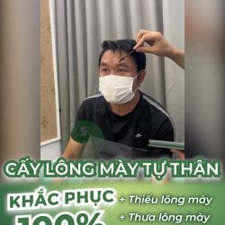 Cấy lông mày tự thân cho khách hàng nam bị mất đuôi lông mày (phần 2)
