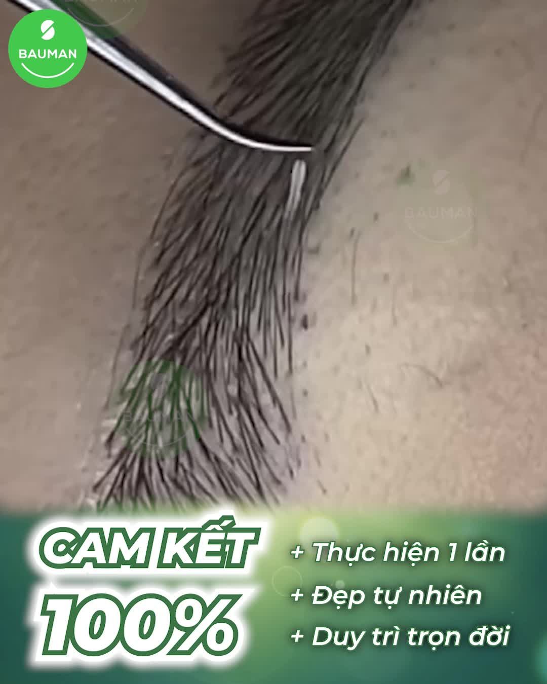 Cấy lông mày được thực hiện như thế nào?