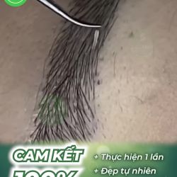 Cấy lông mày được thực hiện như thế nào?