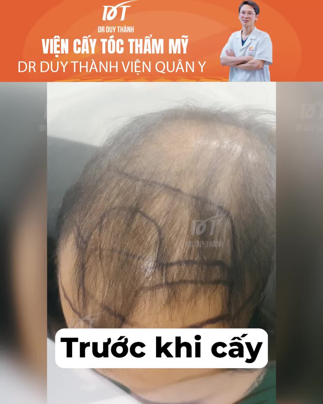 Lột xác ngoạn mục sau cấy 1900 nang tóc tại Dr Duy Thành