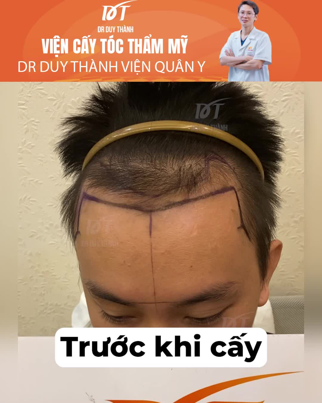 Hạ đường chân tóc bằng cấy tóc DHI 1600 nang chi tiết từ ngày đầu tiên đến tháng thứ 5
