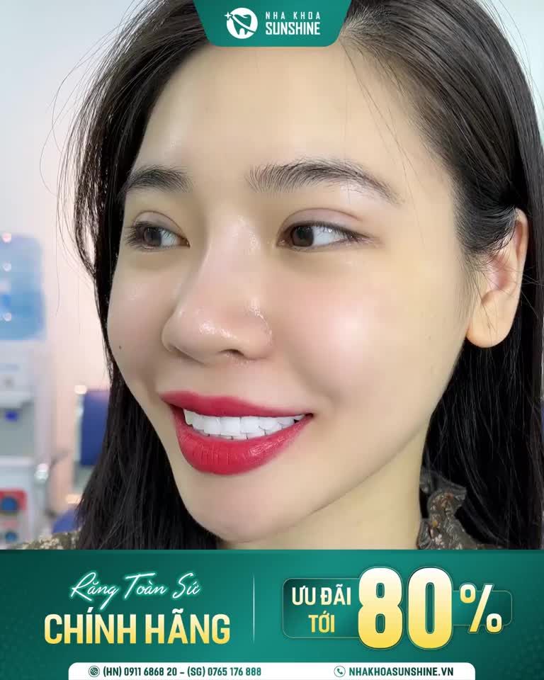 QUÊN NHỮNG LOẠI RĂNG SỨ KIM LOẠI KÉM CHẤT LƯỢNG
