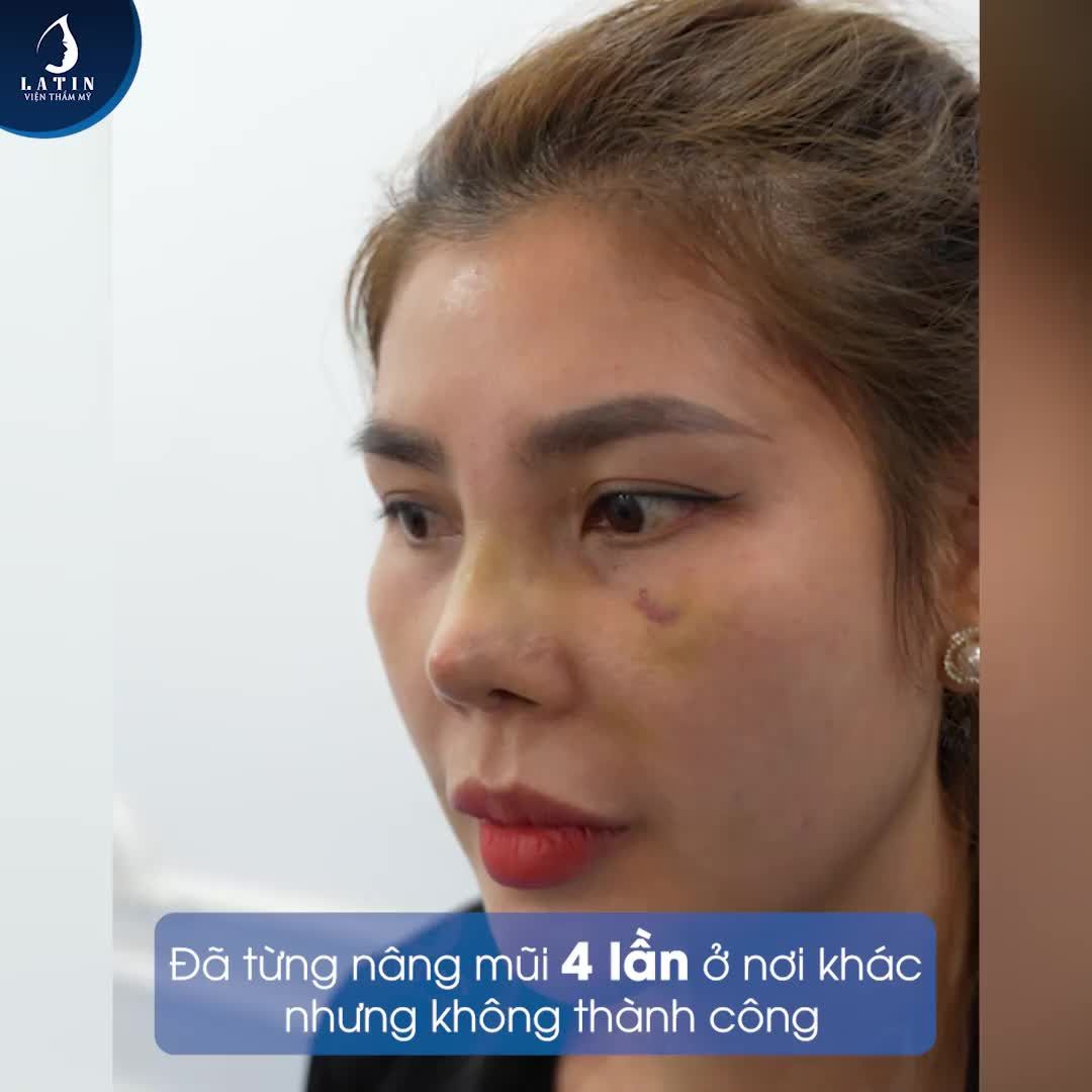 Với dáng mũi ban đầu thấp và kém xinh, chị đã quyết định can thiệp thẩm mỹ để trở nên tự tin hơn.