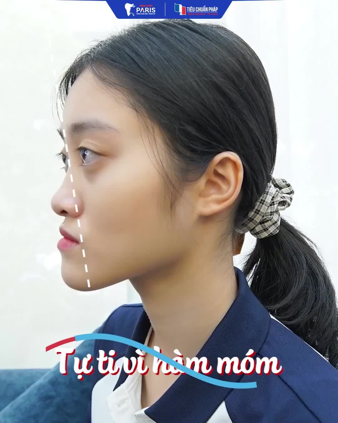 "GEN Z" LẦN ĐẦU "CAN ĐẢM" PHẪU THUẬT HÀM MÓM TẠI BỆNH VIỆN RHM PARIS...