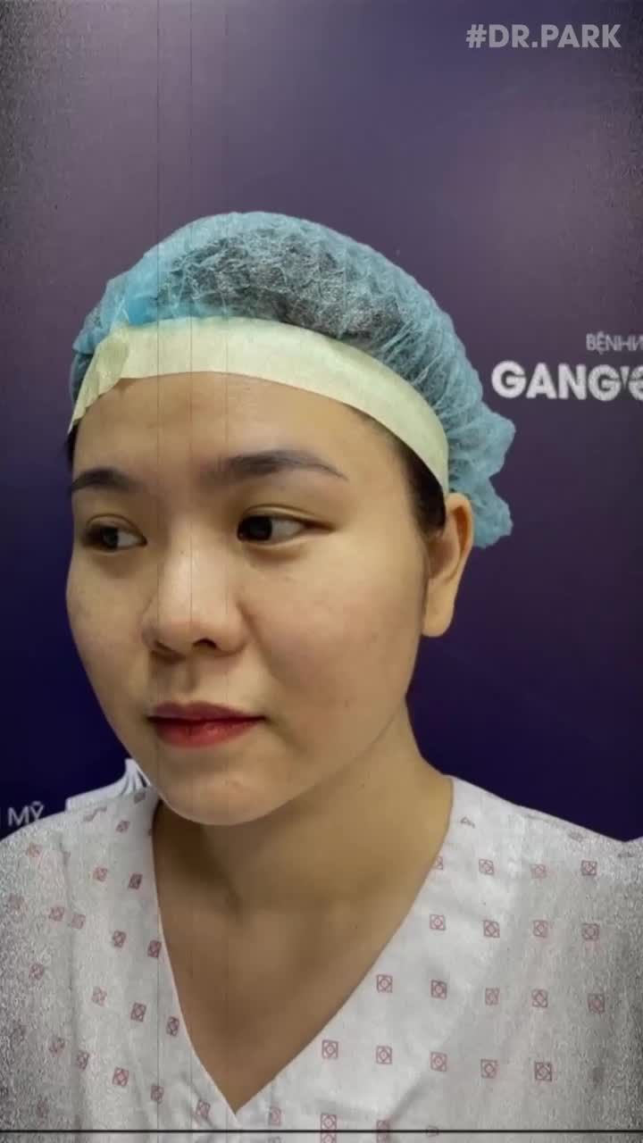 NÂNG MŨI - CẮT MÍ NÊN LÀM 1 LẦN HAY 2?