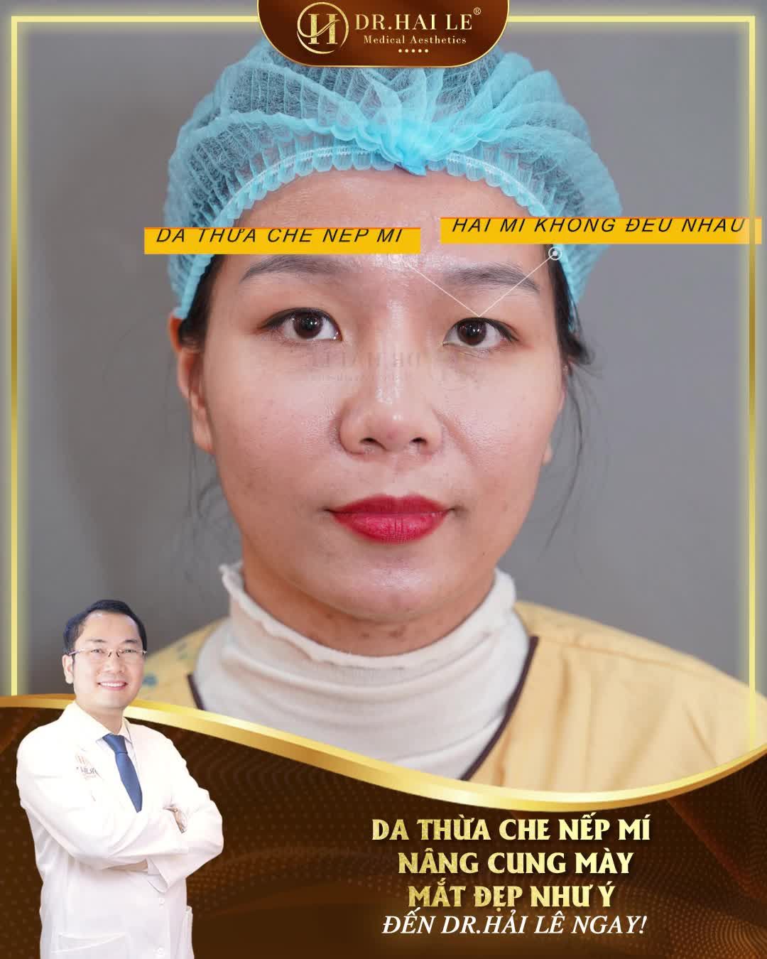 Da thừa che đi nếp mí, giải pháp nào lấy lại sự tươi trẻ cho đôi mắt?