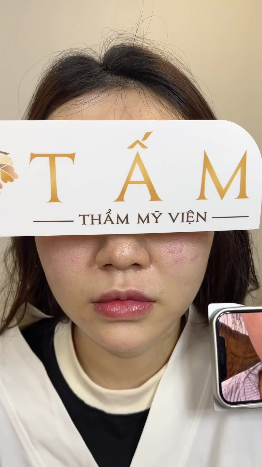 ca filler môi của chị Phương tại phòng khám thẩm mỹ viện Tấm. Dáng môi đã được cân chỉnh đầy đặn, tự nhiên phù hợp với khuôn mặt của chị khách.