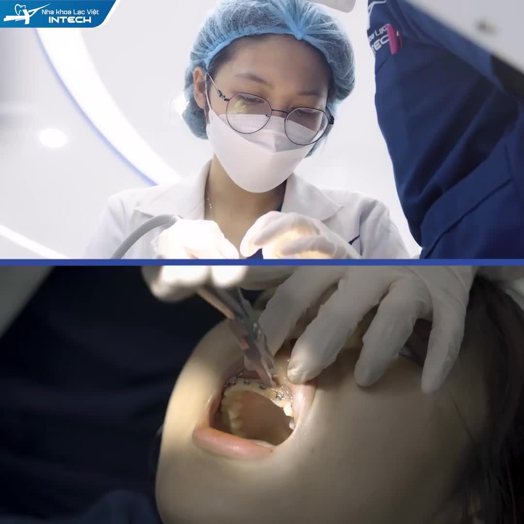TẠM BIỆT KHỚP CẮN HỞ, RĂNG KHẤP KHỂNH SAU 2 NĂM NIỀNG RĂNG CÔNG NGHỆ X-MATRIX TẠI LẠC VIỆT INTECH