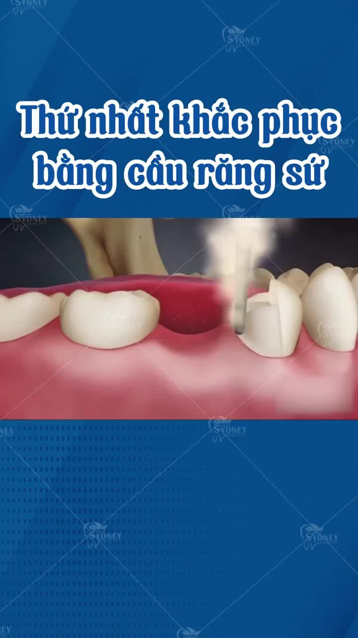 Trồng răng hết bao nhiêu tiền? Các phương pháp khắc phục?
