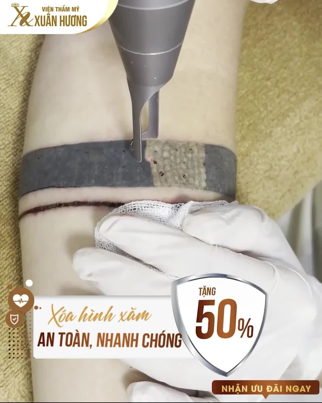 Hình xăm phai màu xanh đỏ, không còn thẩm mỹ hay phù hợp công việc