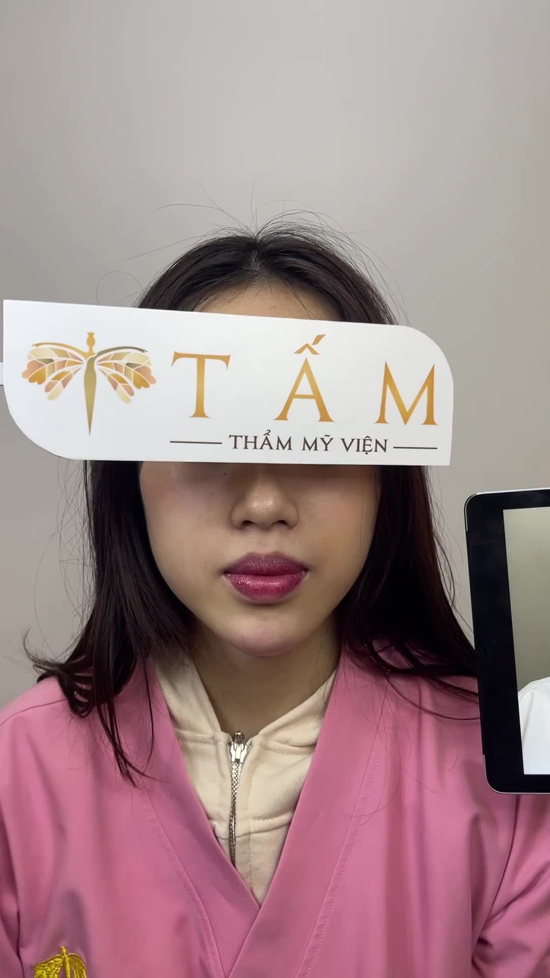 Chị Lan trước đây có dáng cằm ngắn, lệch, không có đỉnh cằm khiến gương mặt chị không được thanh thoát.