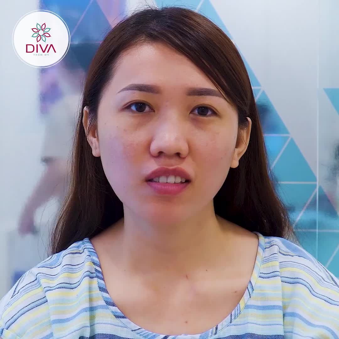 KẾT QUẢ SAU 3 TUẦN NÂNG MŨI, LẤY MỠ MÍ DƯỚI, TIÊM MỠ COLEMAN MẶT NHƯ THẾ NÀO?