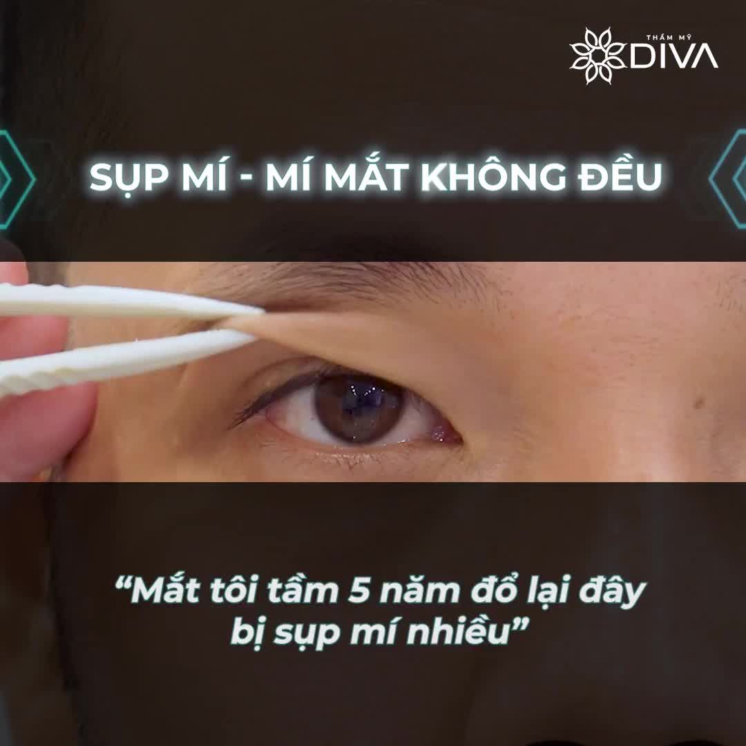 SỤP MÍ  - MÍ MẮT KHÔNG ĐỀU PHƯƠNG PHÁP NÀO CẢI THIỆN?