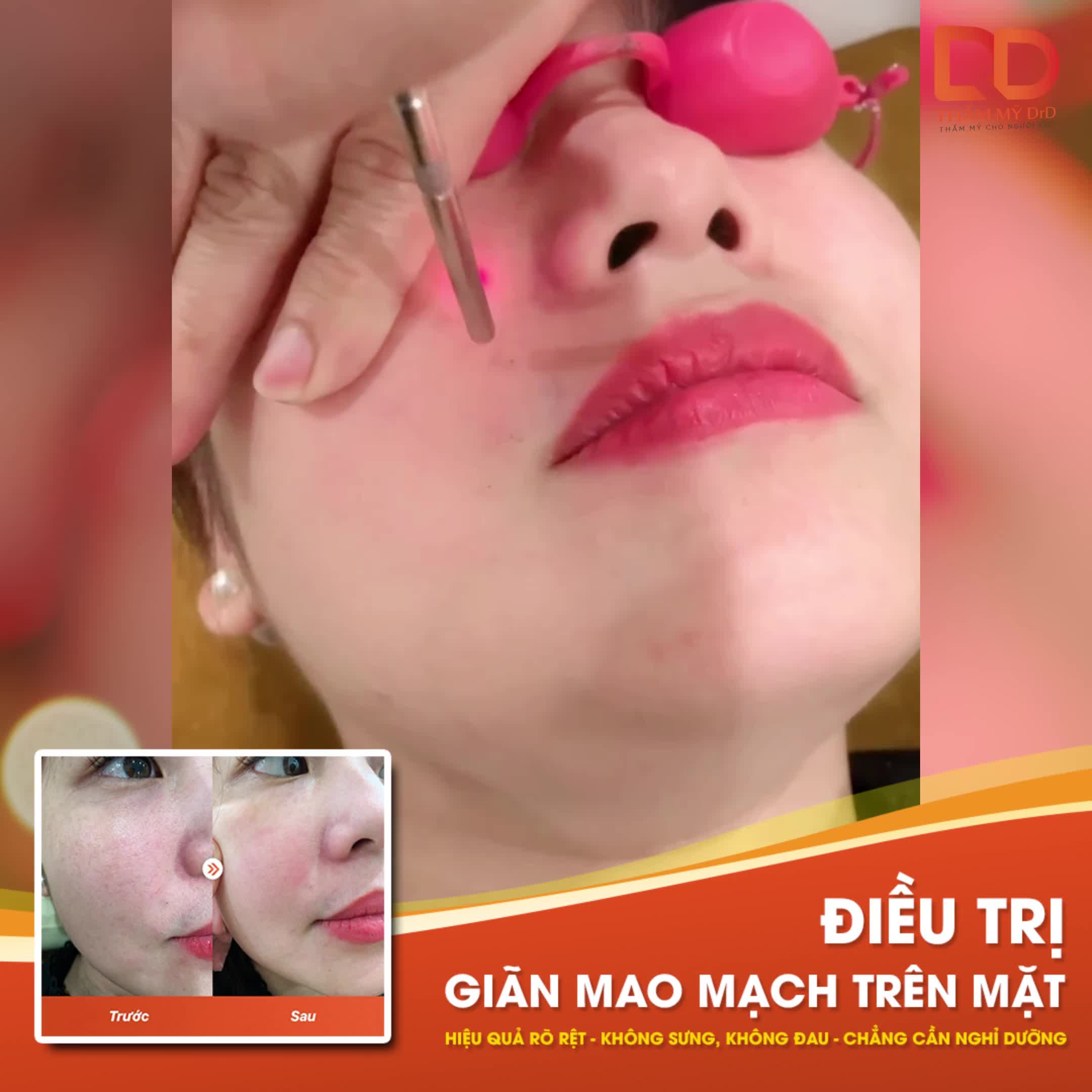 ĐIỀU TRỊ GIÃN MAO MẠCH TRÊN MẶT HIỆU QUẢ RÕ RỆT