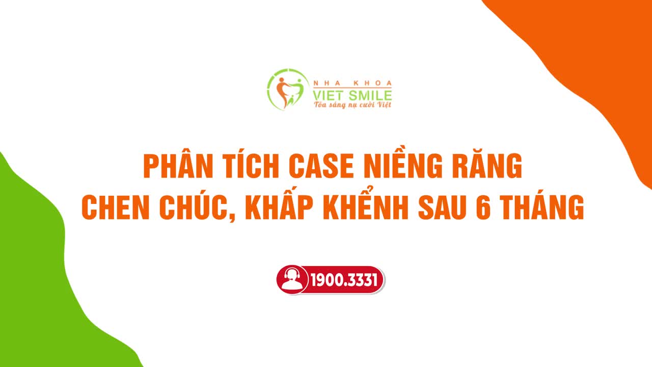 THAY ĐỔI RÕ RỆT SAU 6 THÁNG NIỀNG RĂNG KHẤP KHỂNH