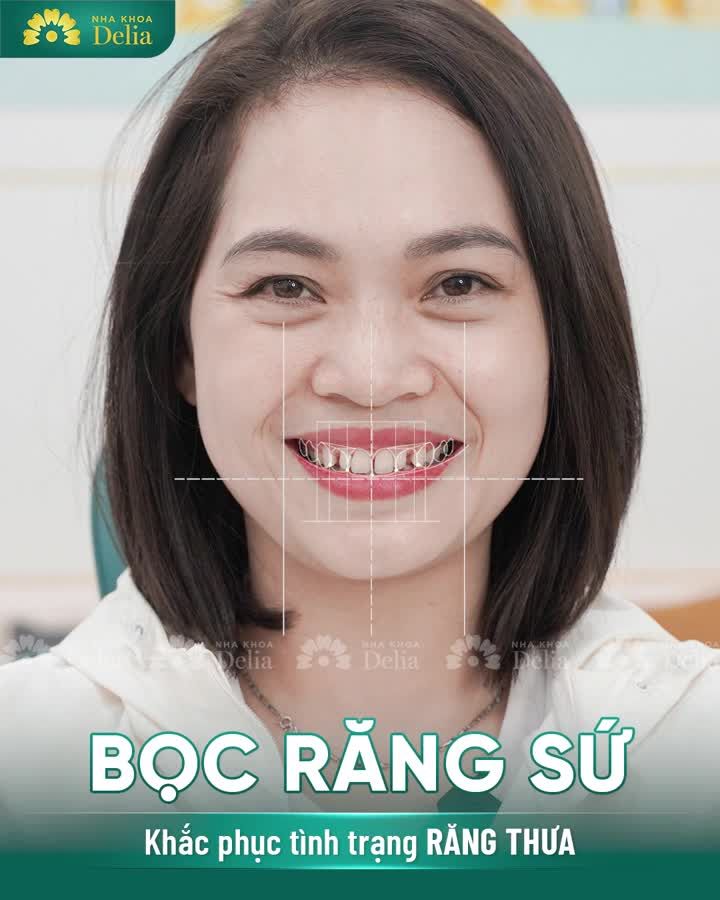 Bọc răng sứ khắc phục Răng thưa, khấp khểnh, ố vàng, sứt mẻ