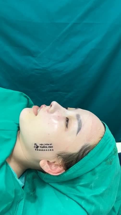 Case mũi cấu trúc vừa hoàn thành cho bạn gái thích tự nhiên .