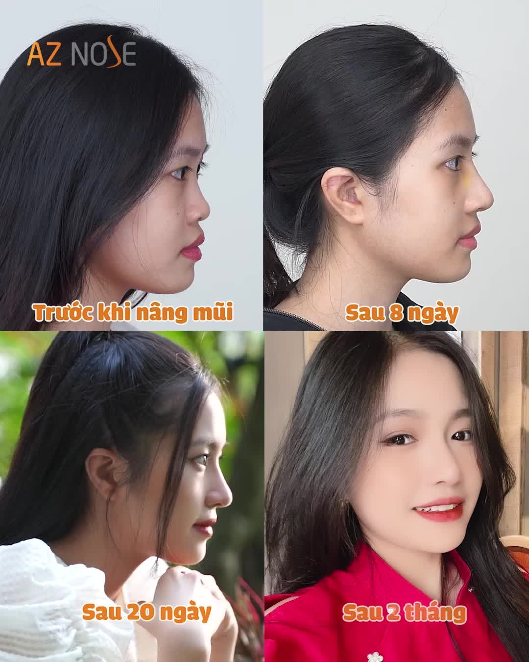 KHÁC BIỆT HẲN SAU 2 THÁNG NÂNG MŨI CẤU TRÚC