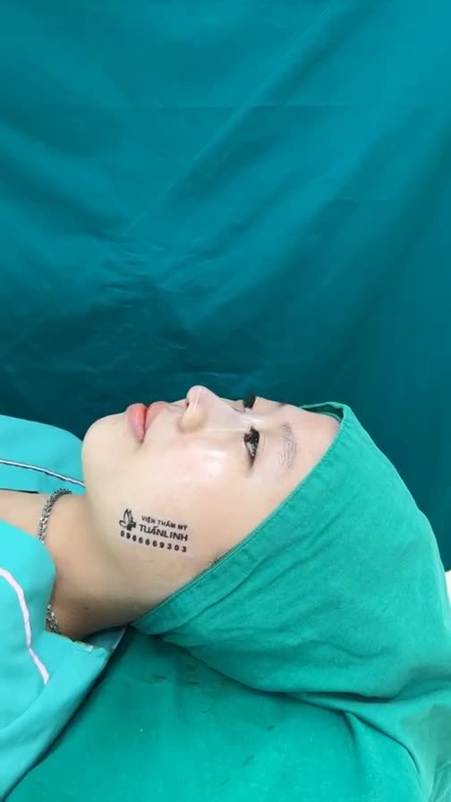 Case mũi bọc sụn vừa mới hoàn thành