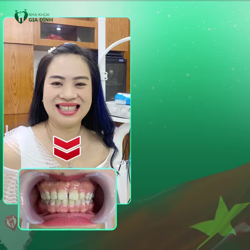 TRẺ RA CHỤC TUỔI NHỜ THẨM MỸ RĂNG SỨ