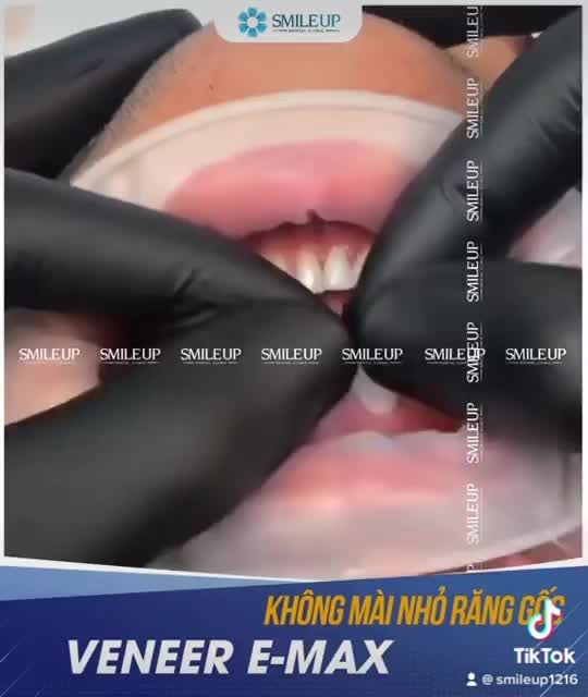Tại Sao Smile Up Luôn Được Hàng Nghìn Khách Hàng Lựa Chọn Dán Sứ Veneer Trong Những Năm Vừa Qua ?