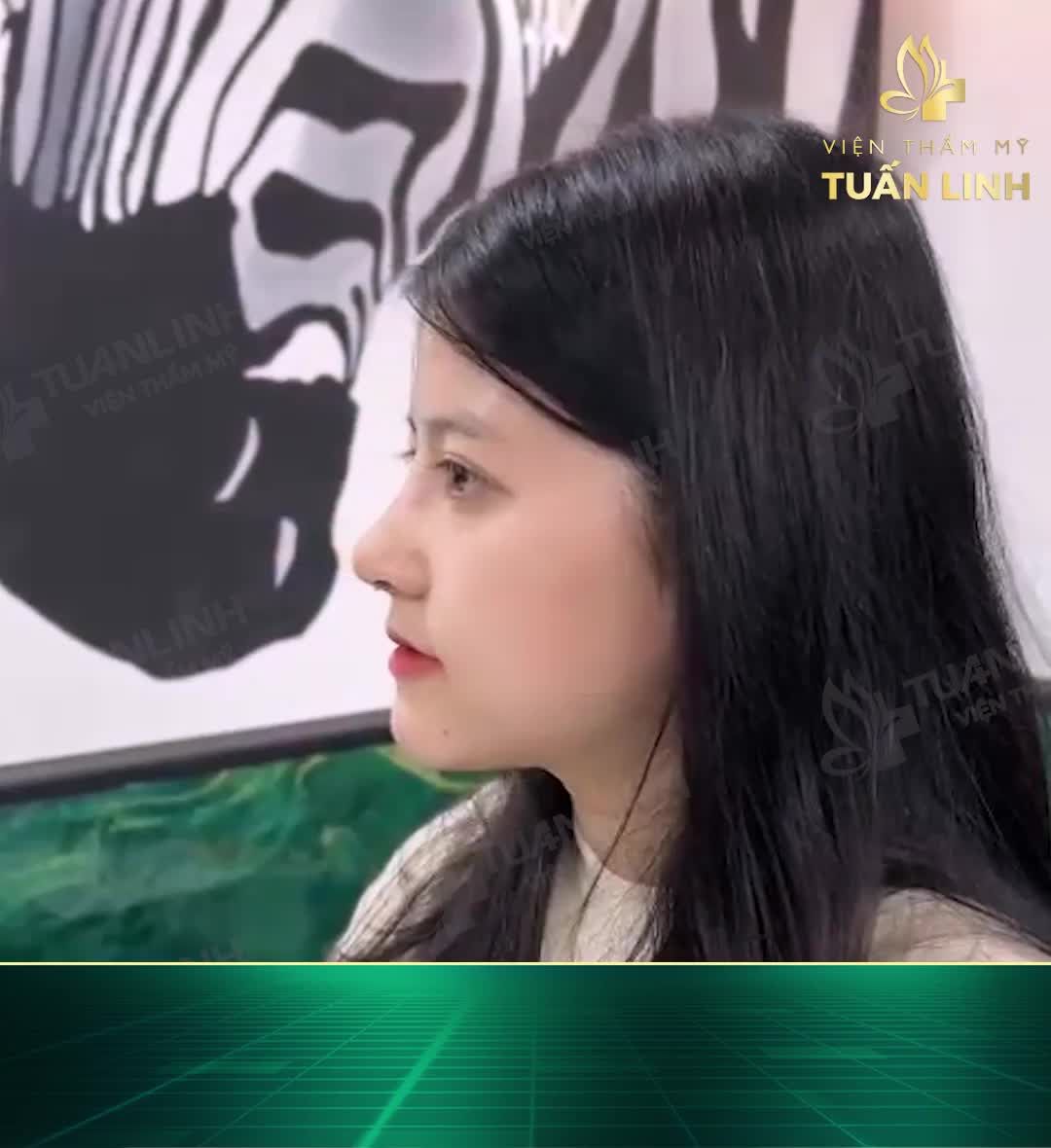 ''Bye Bye'' chiếc mũi ngắn hếch, thấp tẹt sau 10 ngày nâng cấu trúc!!
