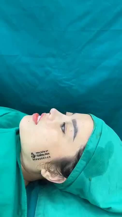 Case mũi cấu trúc surgiform vừa hoàn thành