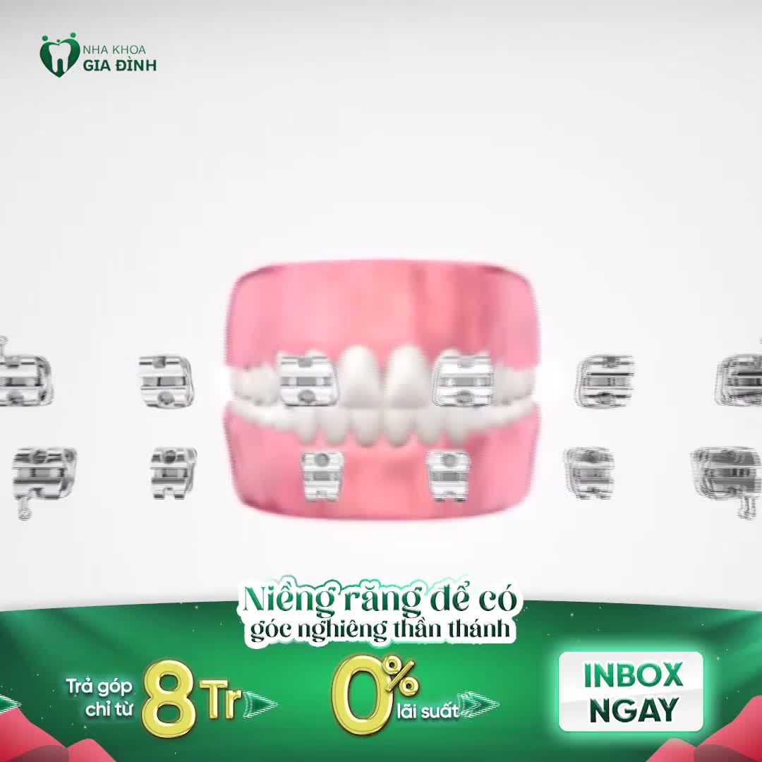 NIỀNG RĂNG ĐỂ CÓ GÓC NGHIÊNG THẦN THÁNH
