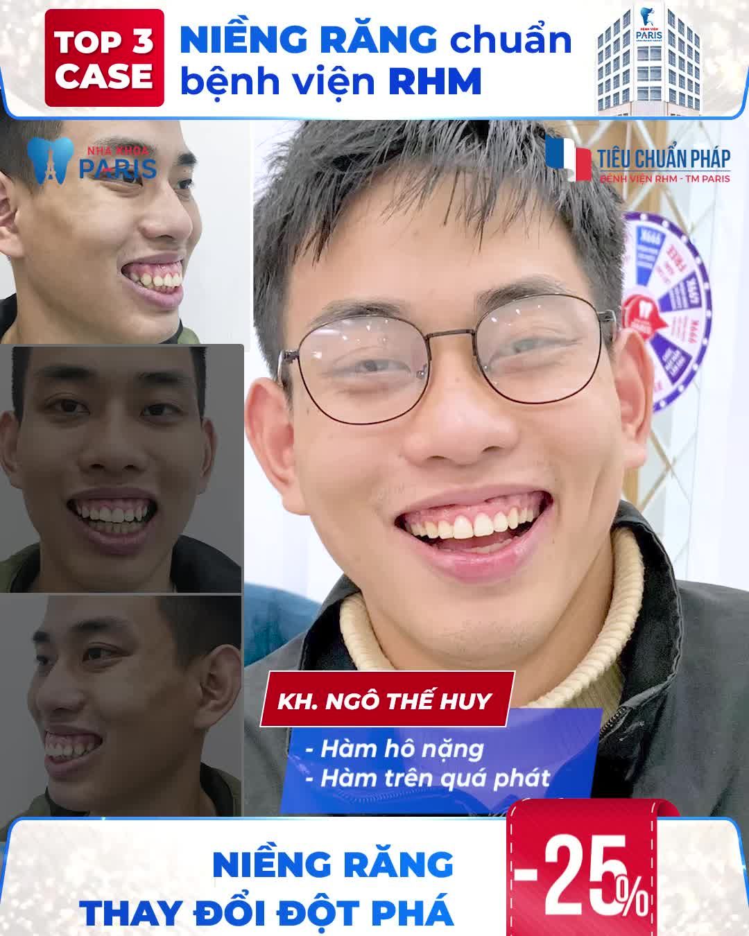 TOP 3 CASE NIỀNG RĂNG CHUẨN BỆNH VIỆN
