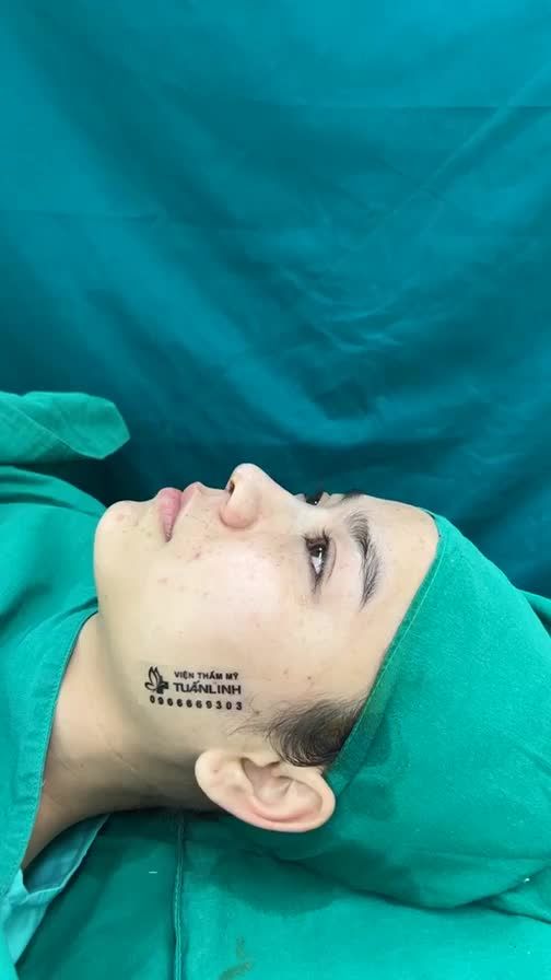 Case mũi cấu trúc + surgiform vừa hoàn thành