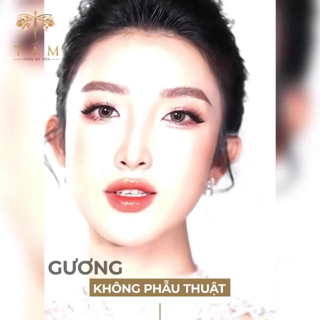 GƯƠNG MẶT NHỎ GỌN KHÔNG CẦN PHẪU THUẬT ĐAU ĐỚN