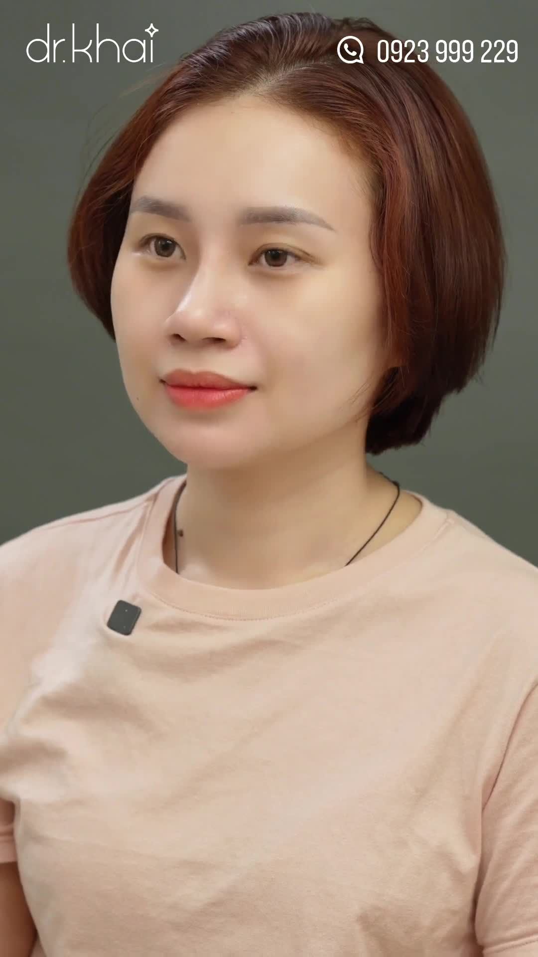 NÂNG MŨI CẤU TRÚC 1 THÁNG - KHÔNG ĐAU, ĐẸP TỰ NHIÊN