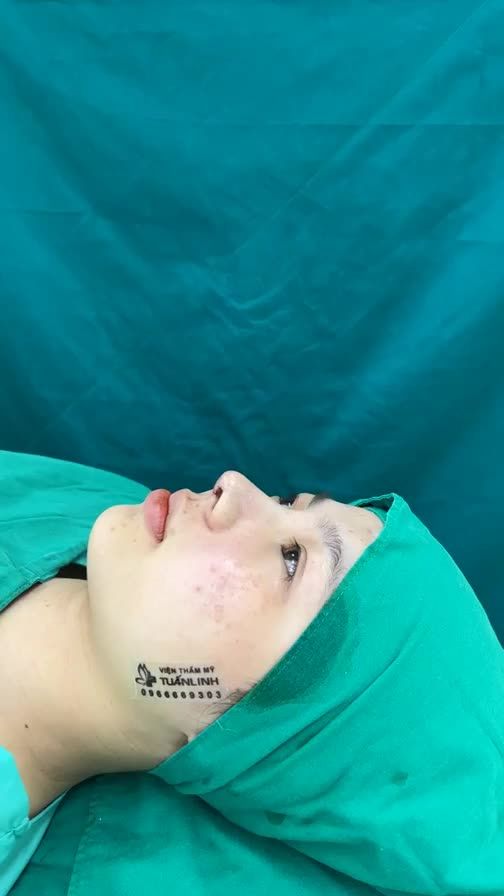 Case mũi cấu trúc vừa hoàn thành